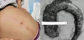Procedimento Incomum na China: Médicos Removem 20kg de Fezes com um Metro de Comprimento do Intestino de uma Mulher