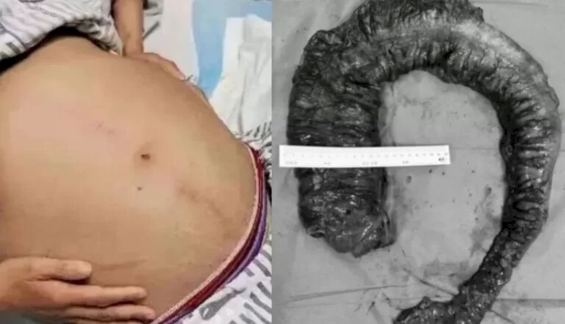 As fezes na barriga da mulher endureceram e médicos tiveram que fzer uma cirurgia de emergência